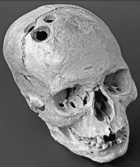 trepanação realizado em um crânio humano